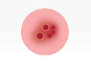 El Herpes Labial Las 5 Etapas De Un Brote De Herpes Labial Orajel El Herpes Labial Las 5 Etapas De Un Brote De Herpes Labial Orajel