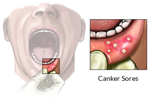 cold sore inside cheek