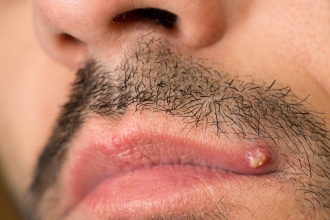 Mustachioed man with a cold sore on the left corner of his upper lip.