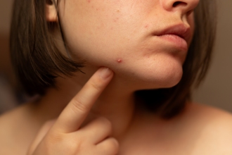 Woman examines a pimple on her face near her chin.
