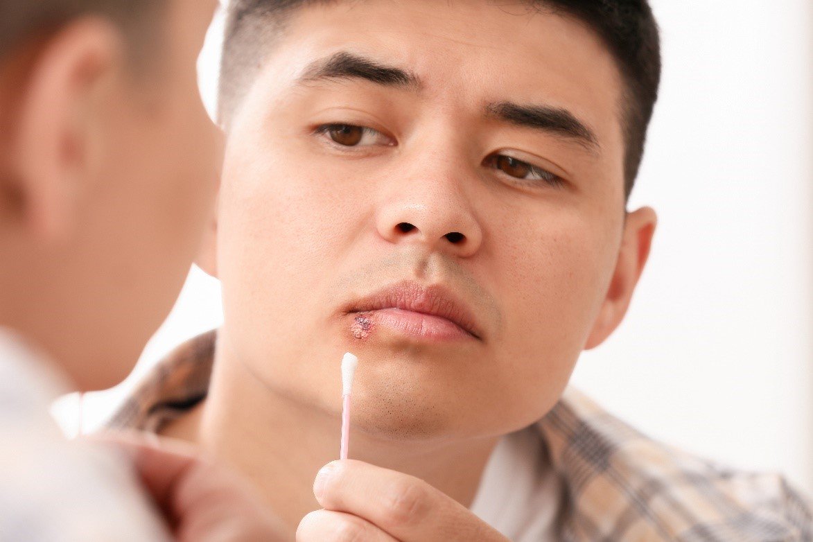 Man treating cold sore with Orajel 3x medicated mouth sore gel using a cotton swab