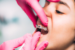 Teen getting braces fitted at orthodontist office